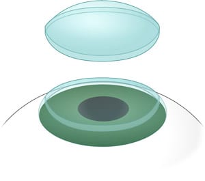 Digital image of a corneal transplant