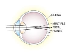 Digital illustration of an eyeball with Astigmatism