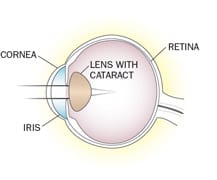 Digital illustration of an eyeball with cataracts