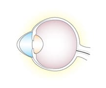 Digital illustration of an eyeball with Keratoconus