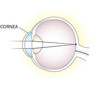Picture of an eyeball without Keratoconus