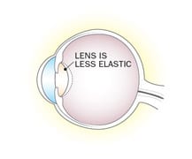 Digital illustration of an eyeball with Presbyopia
