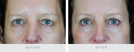 Before and After Photo: Bilateral Upper and Lower Lid Blepharoplasty, Browplasty