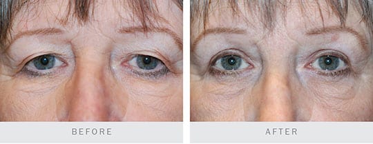 Before and After Photo: Bilateral Upper Lid Blepharoplasty