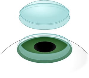 Digital illustration of a corneal FEMO transplant